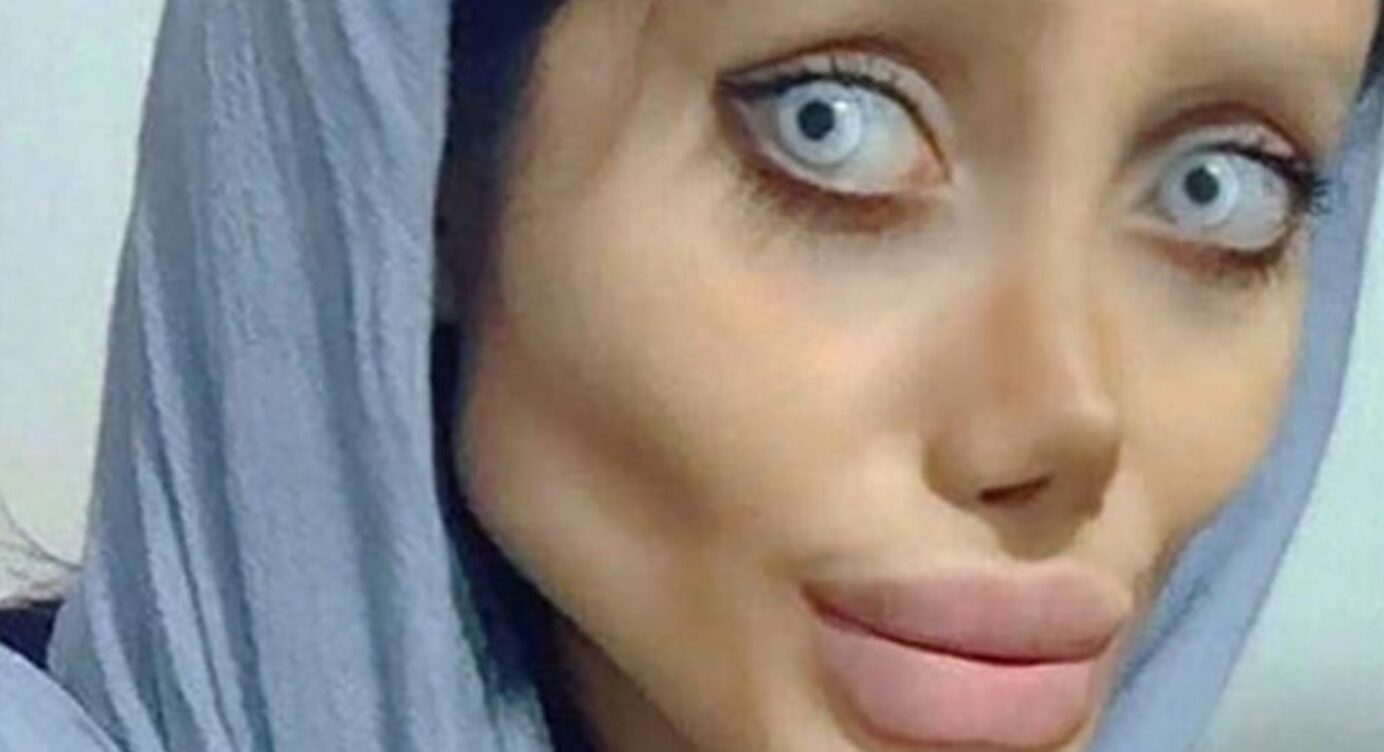 50 Beauty-OPs! Diese Frau will wie Angelina Jolie aussehen